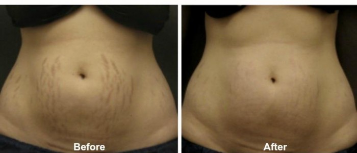 Image result for fraxel dual for revision of stretch marks before and after