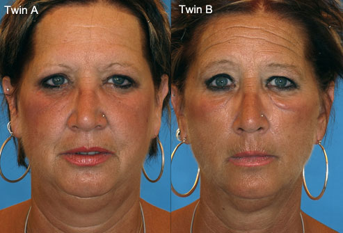Photo of identical twins, one smoker
